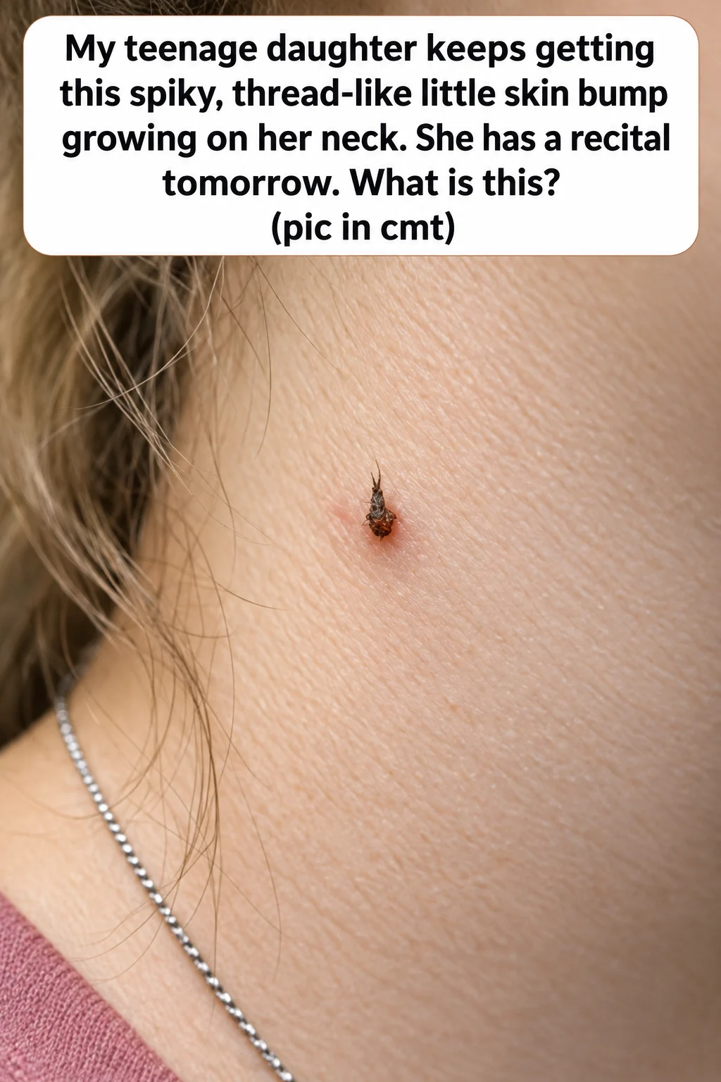 Filiform wart on neck appearing as a small spiky thread-like skin bump